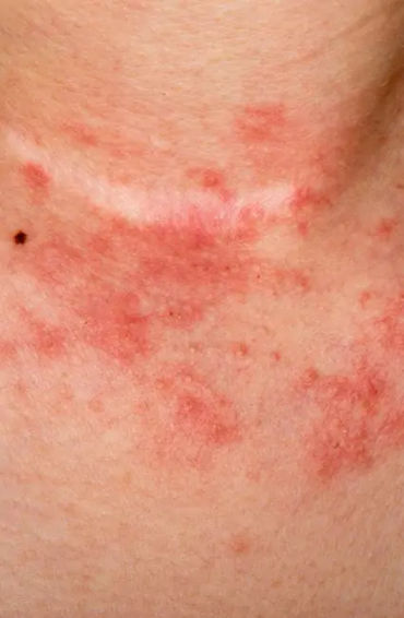 Eczema