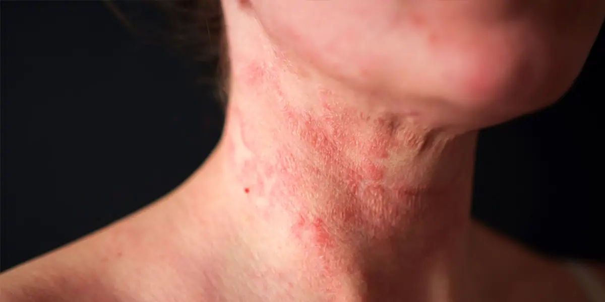 Eczema 