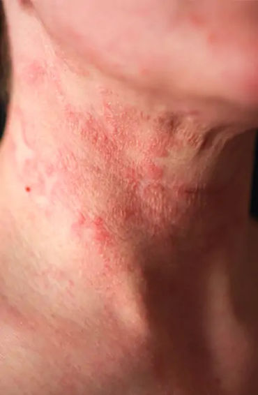 Eczema 