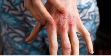 atopic dermatitis