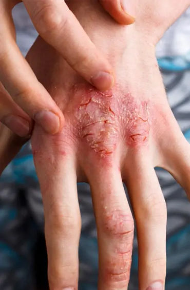 atopic dermatitis