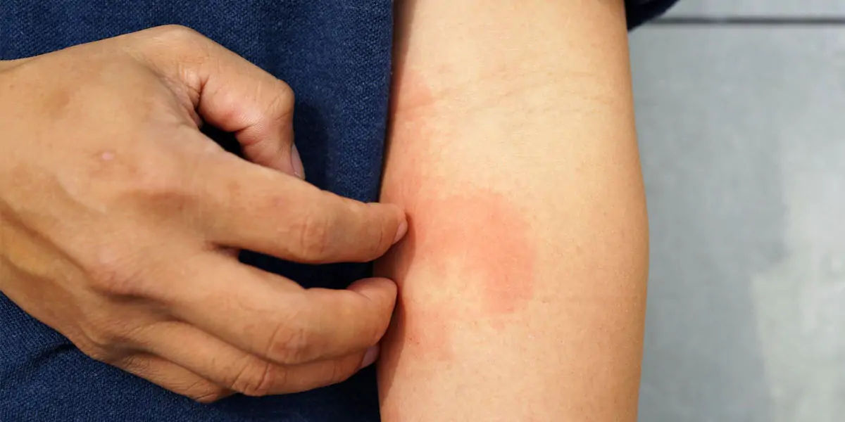 eczema, inflammatory skin, atopic dermatitis, skin