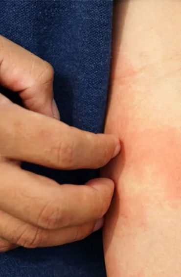 eczema, inflammatory skin, atopic dermatitis, skin