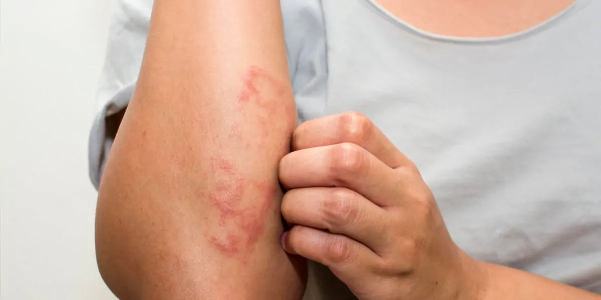 eczema, inflammatory skin, atopic dermatitis, skin