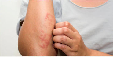 eczema, inflammatory skin, atopic dermatitis, skin