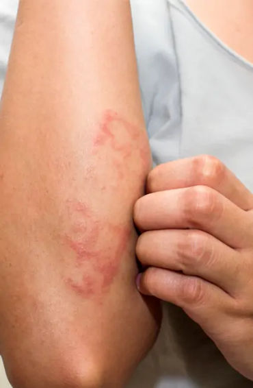 eczema, inflammatory skin, atopic dermatitis, skin