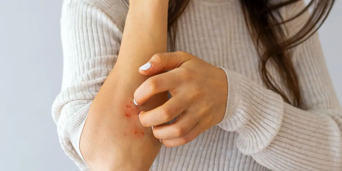 eczema, inflammatory skin, atopic dermatitis, skin