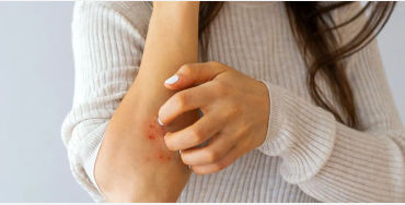eczema, inflammatory skin, atopic dermatitis, skin