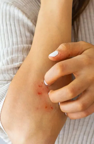 eczema, inflammatory skin, atopic dermatitis, skin