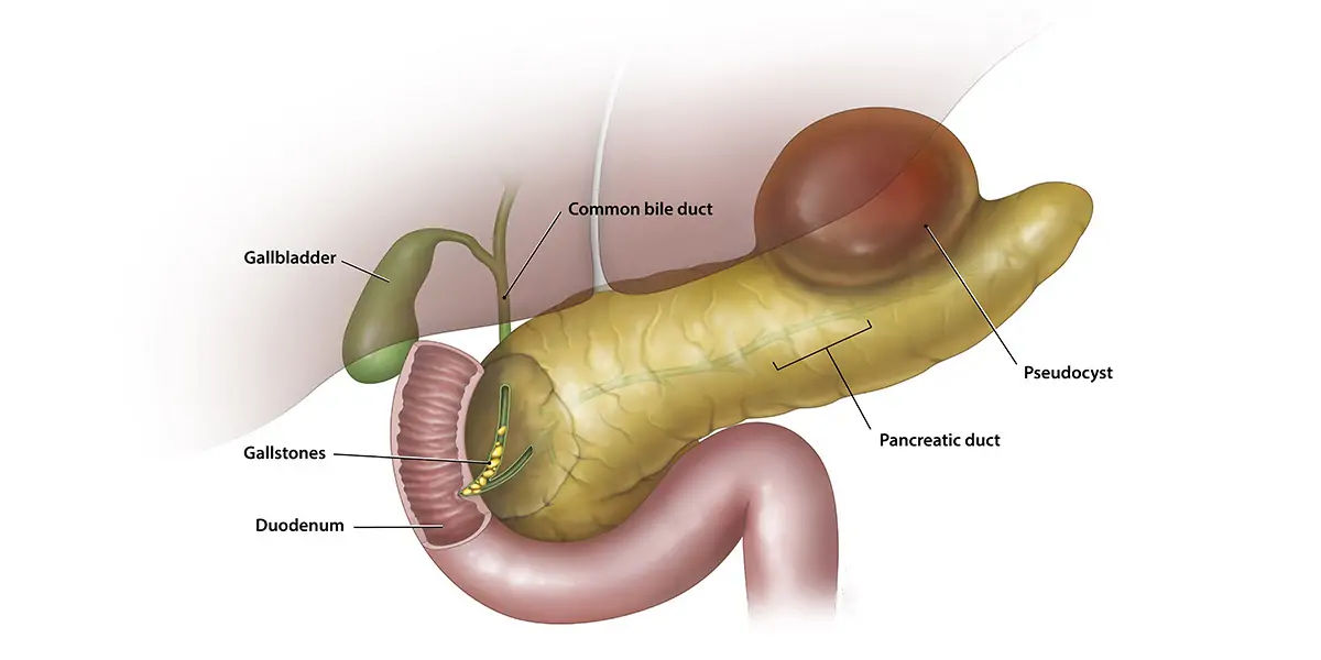 Pancreatitis