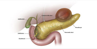 Pancreatitis