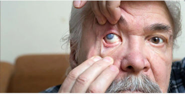 cataracts