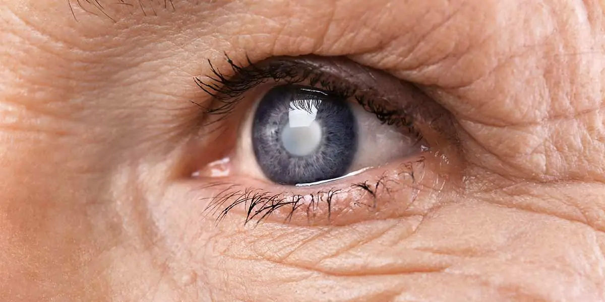 CATARACTS