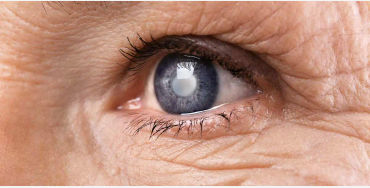 CATARACTS