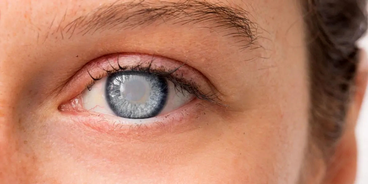 CATARACTS 