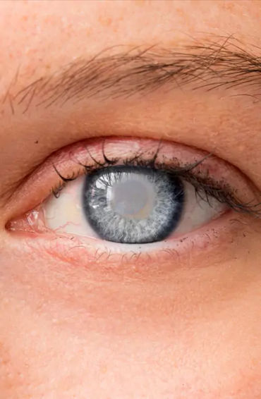 CATARACTS