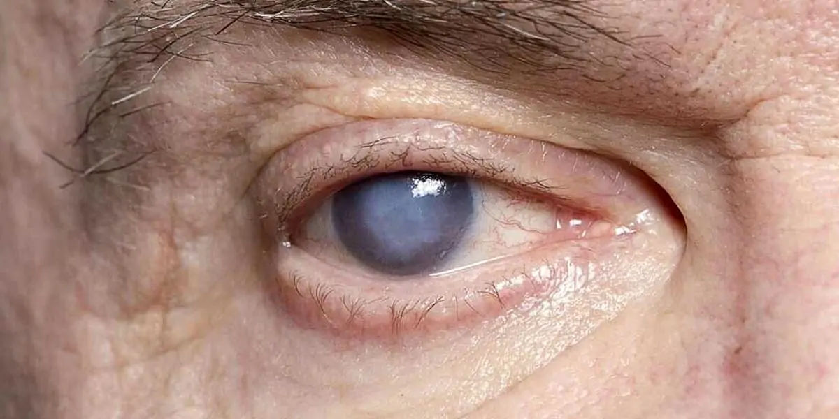 cataracts, eye, injury, operation