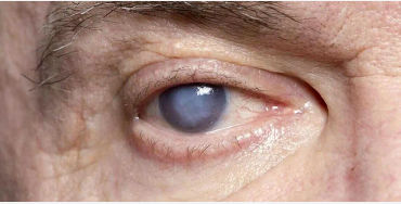 cataracts, eye, injury, operation