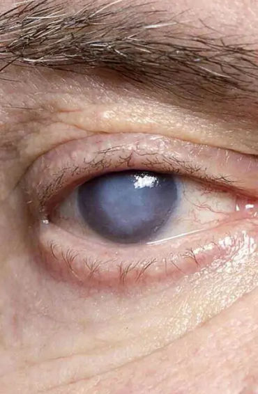 cataracts, eye, injury, operation