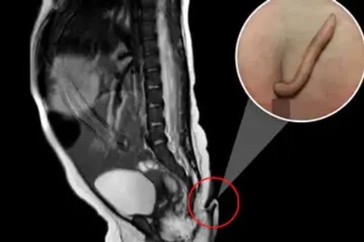 tailed girl born in mexico only 40 such cases in the world