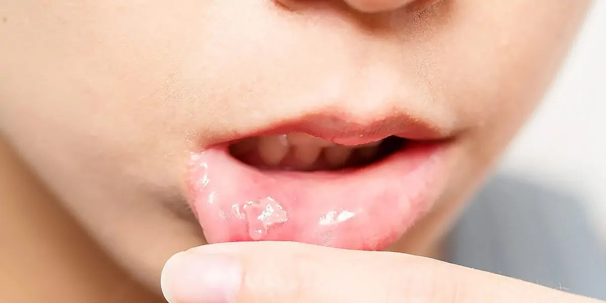 Ulcers 