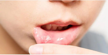 Ulcers 