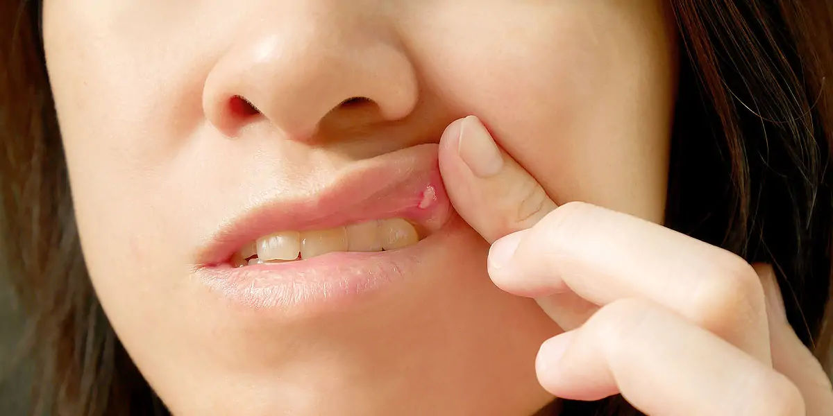 ulcers, bacteria, pain, infection