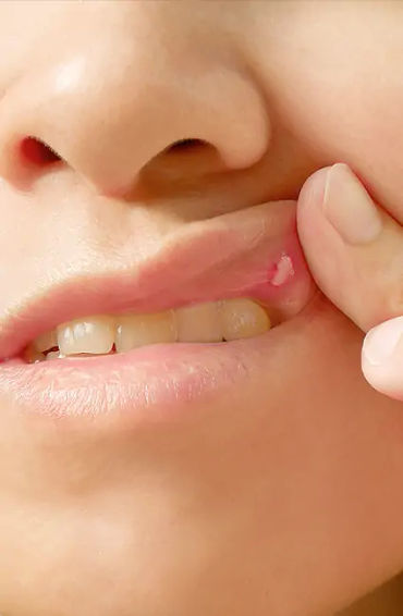 ulcers, bacteria, pain, infection