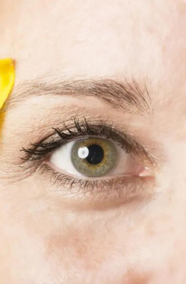 heterochromia, eye disorder