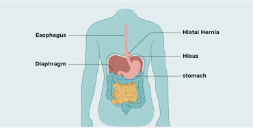 hernias, abdominal walls 