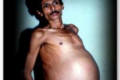man was pregnant for 36 years twins came out after operation