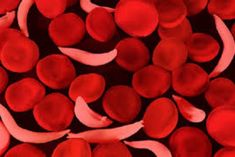 sickle cell anemia eradication will start today in jharkhand