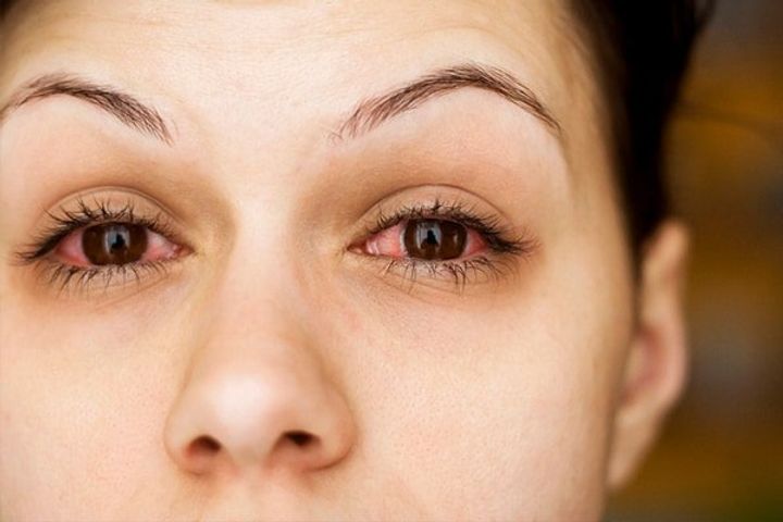 conjunctivitis cases are on the rise in delhincr