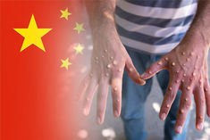 monkeypox infection wreaks havoc in china